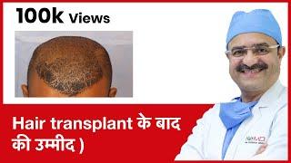 Hair Growth: What To Expect After Hair Transplant (Hair transplant के बाद की उम्मीद ) | (In HINDI)