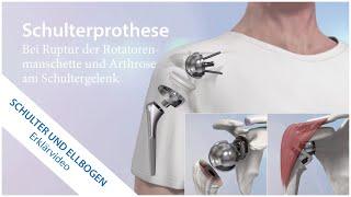 Schulterprothese bei Arthrose am Schultergelenk