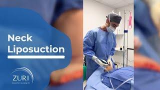 Neck Liposuction