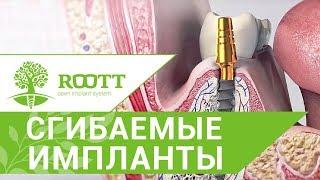 Зубные импланты технология.  О современных технологиях зубных имплантов. ROOTT