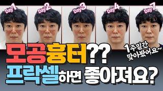 피부과전문의가 맞아봤습니다. 모공, 흉터 치료에 좋다는 프락셀. 여드름흉터원정대 21탄.