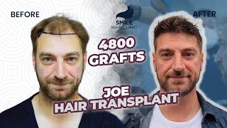 Turning Back the Clock: Incredible Results of a 4800 Graft Hair Transplant | Before and After