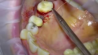 Placing a Straumann BLX Dental Implant