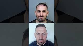 6 MONTHS UPDATE AFTER HAIR TRANSPLANT - SMILE HAIR CLINIC