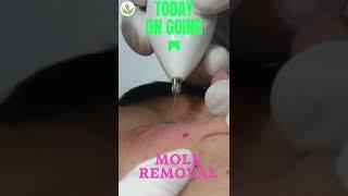 Mole Removal Treatment | Effective & Safe Solutions at Care Well Medical Centre