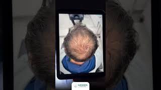 Erleben Sie die Transformation durch Haartransplantation!