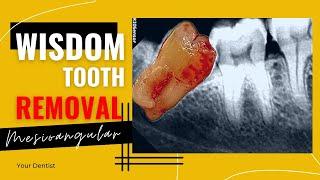 Wisdom tooth removal within 5 min full video | Impacted tooth extraction | your dentist #extraction