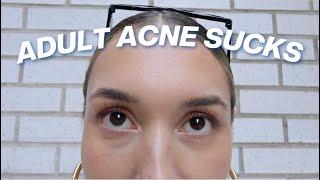 FINALLY clearing my adult acne! (my current skincare favs)