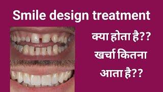 Smile design treatment// Smile makeover//स्माइल डिज़ाइन ट्रीटमेंट क्या होता है और इसका खर्चा