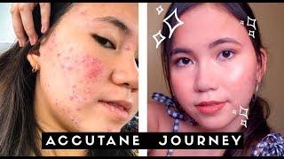 HOW I CURED MY ACNE FOR GOOD | MARY BAUTISTA