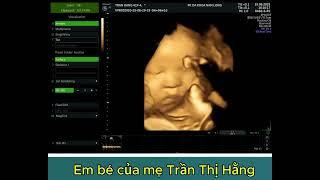 EM BÉ CỦA MẸ TRẦN THỊ HẰNG - VIỆT XUÂN VĨNH TƯỜNG VĨNH PHÚC - THAI 36 TUẦN 3 NGÀY