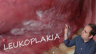 Leukoplakia: Common Oral Pathology