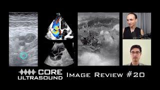 Core Ultrasound Image Review, Episode 20!