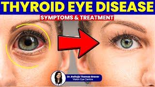 Thyroid Eye Disease: Symptoms & Treatment Explained