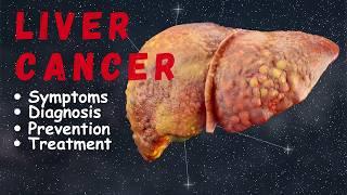 Liver Cancer: Symptoms, Diagnosis, Stages, and Treatment Options