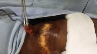 Vitiligo Surgery in Varanasi in 3 Steps by Dr. Prashant Baranwal - Vitiligo Treatment Before After