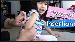 Step By Step Dexcom CGM Insertion | The Dose Family