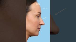 Before and after results: Rhinoplasty (Nose Job) with Dr. Wise in Wayne, NJ!