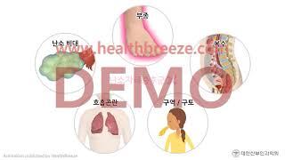 [시연용] c0174aako_[대한산부인과학회] 자연주기 시험관아기 시술 안내