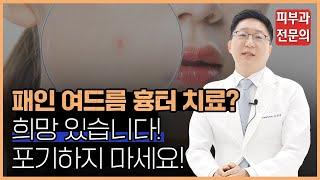 여드름 흉터 치료 '이렇게' 하시면 됩니다!ㅣ 피부과전문의