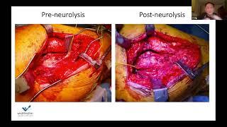 Nerve palsy following surgery? What are the possible causes! CY Ng nerve surgeon explains