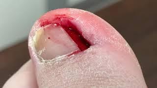 JAWSNORMOUS EXTRACTIONS OF DOUBLE  INGROWN TOENAILS (wait for the 2nd one) 