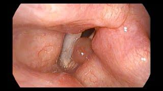 Large Vocal Polyp Causing Hoarse Voice