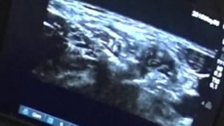 PULSED RF C6