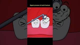 process of teeth fracture