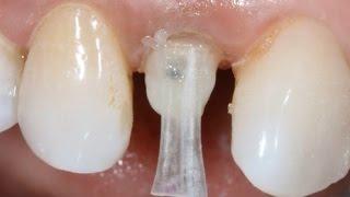 Repairing Fractured Post Endo Buildup with Dentapreg by Dr. Eric Van Zytveld