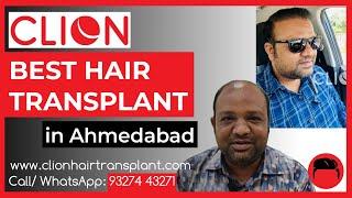 Best Hair Transplant in Ahmedabad - 7 th Grade Baldness | Hair Transplant | 1st sitting 3700 grafts