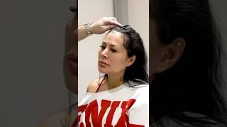 Adriana Müller Cosmedica Clinic Hair Transplant in Turkey #shorts #hairtransplant #video