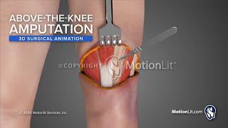 Surgical Animation Portrays Above-the-Knee Amputation