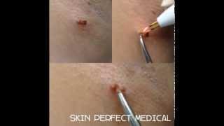 Virtually Painless Skin Tag Removal