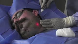 SmartLipo treatment to neck