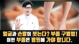 얼굴과 손발이 자주 붓는다. 부종의 원인별 대처법. 이런 부종은 병원에서 검사가 필요합니다. 반대로 이런 부종은 병원에 안가도 됩니다.