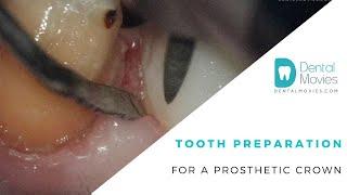 Tooth preparation for a prosthetic crown