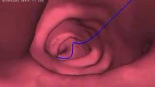 Roberta Rietti: CT Colonography Master Thesis
