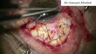 Ahmed Valve Implant For Neovascular Glaucoma Patient