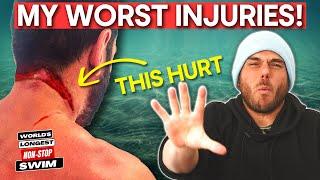 The WORST (5) Injuries: Long-Distance Swimming!