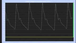 Pulse Wave Analysis