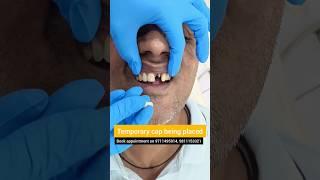 Temporary Cap over Front Dental Implant? Try Maryland Bridge! Dr. Srishti Bhatia #teeth #dental