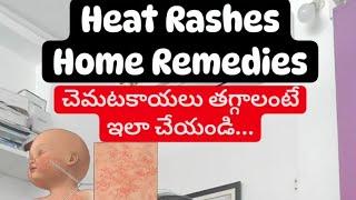 Heat Rashes Home Remedies For kids - Dr Pasunuti Sumanth