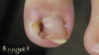GRANULOMA GIGANTE SUBUNGUEAL #satisfying #nails