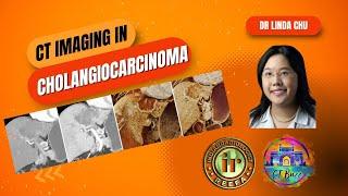 Linda Chu | Cholangiocarcinoma