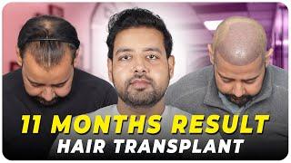 Hair Transplant in Salem | Best Results & Cost of Hair Transplant in Salem