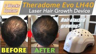 6 weeks update - Theradome EVO LH40 Laser Hair Growth Device