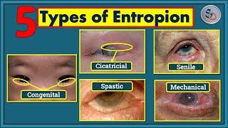 5 Types of Entropion you should know.