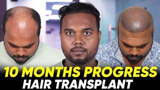 Hair Transplant in Salem | Best Results & Cost of Hair Transplant in Salem