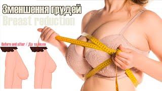 Breast reduction / Зменшення та підтяжка грудей в Україні